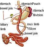 RNY Gastric Bypass